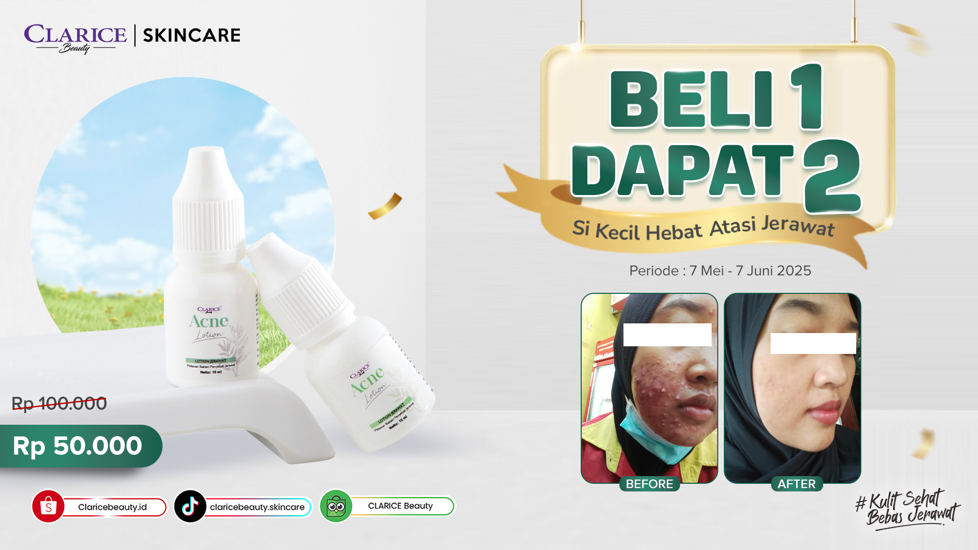 BELI 1 DAPAT 2 - ACNE LOTION - LANDINGPAGE